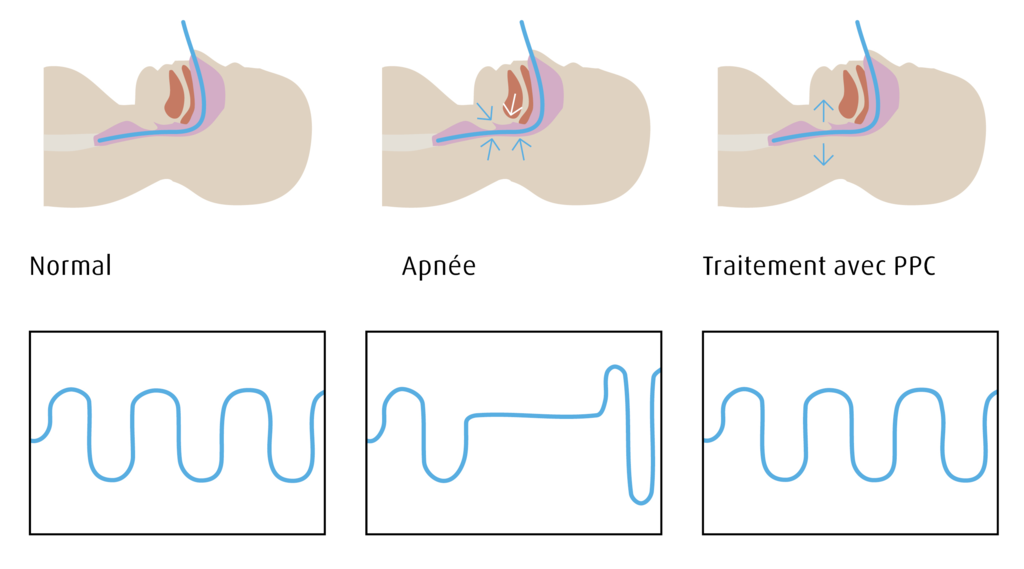 sleep apnea illustration